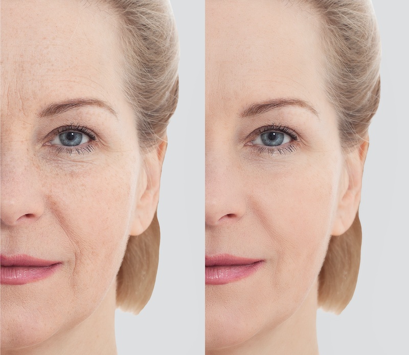 before and after a facelift at Midwest Facial PLastic Surgery
