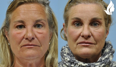 Brow/Forehead Lift before and after photo by Midwest Facial Plastic Surgery in Minnesota