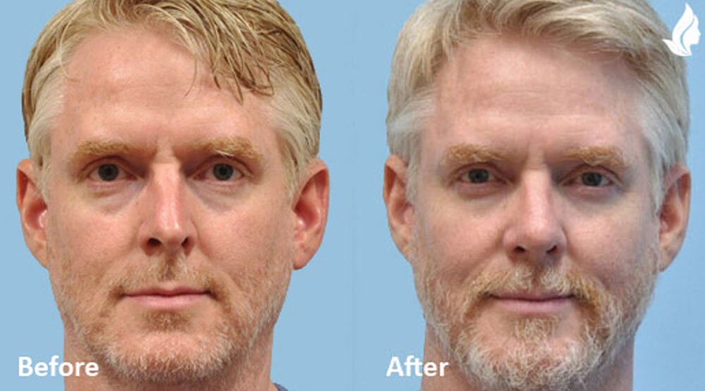 rhinoplasty before and after gallery images