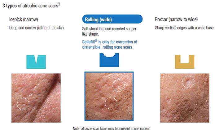 Infographics about 3 Types of Atrophic Scars